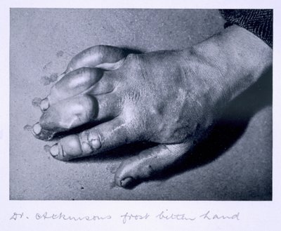 La mano congelata del Dr. Atkinson, 1911 da Herbert Ponting